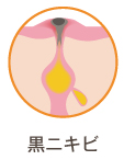 黒ニキビ