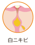 白ニキビ