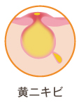 黄ニキビ
