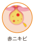赤ニキビ