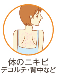 体ニキビ（背中、デコルテのニキビ）